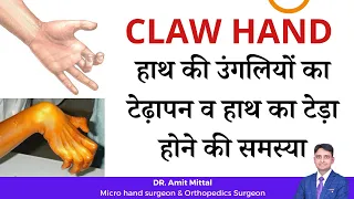 हाथ की उंगलियों का टेढ़ापन व हाथ का टेड़ा होने की समस्या | CLAW HAND EXPLAINED in Hindi