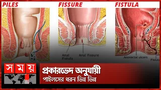 পাইলস, ফিসার ও ফিস্টুলার মধ্যে পার্থক্য কী? | Piles | Fissure | Fistula | Somoy TV