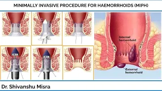 MINIMALLY INVASIVE PROCEDURE FOR HAEMORRHOIDS (MIPH)