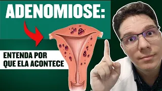 ADENOMIOSE UTERINA: VEJA QUAIS SÃO OS SINTOMAS E COMO É FEITO O DIAGNÓSTICO E TRATAMENTO!