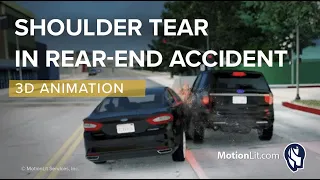 Shoulder Tear In Rear-End Accident 3D Animation With Mech of Injury