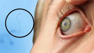 FLOATING PARTICLES IN THE EYE DISAPPEAR FOREVER! Take this natural remedy…