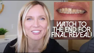 Do You Have a Dark Tooth? Here's the Fix!