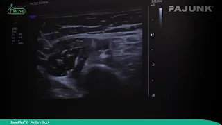 Axillary Block with SonoPlex® II   Nerve Block Procedure