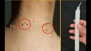 With just one candle, get rid of warts, they will disappear and die forever / treatment of skin tags