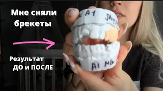 МНЕ СНЯЛИ БРЕКЕТЫ // РЕЗУЛЬТАТ ДО и ПОСЛЕ // КАК ЭТО БЫЛО?! 👈