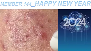 Acne Treatment Huong Da Nang# 144 | Member Happy New Year