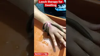 Do leeches reduce swelling? #leechtherapy #kzhijama#shorts#tranding#swelling#reels #viral#cupping