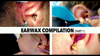 MASSIVE EARWAX REMOVAL COMPILATION (Part 1) | Dr. Paul