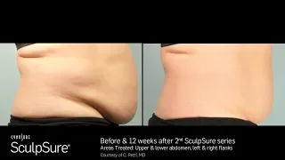 SculpSure - Allcare For Wome