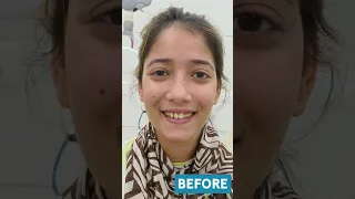 Laser Gum Reshaping- Gingivoplasty by Dr. Srishti Bhatia