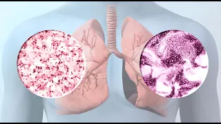 Lung Cancer: 9 Common Treatment Options