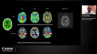 Webinar: State-of-the-art brain CT perfusion in acute ischemic stroke