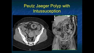 CT Evaluation of Small Bowel Tumors: Detection & Classification - Part 3