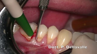 Triple root coverage with connective tissue graft