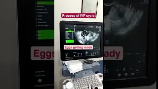 And that’s how the parenthood happiness of lakhs of couples starts at Indira IVF!