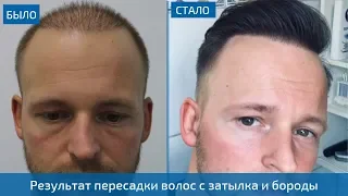 Результат пересадки волос на голову мужчине с бороды и затылка - 4300 графтов