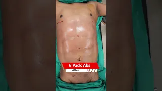 6 Pack Abs surgery | Six Pack Abs surgery Result | Liposuction cost #shortvideo #shots