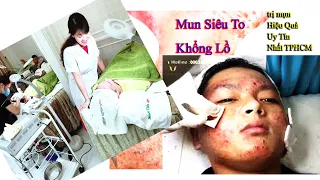 how to get rid of acne,blackheads,acne treament at Hien Van Spa- Đại Hoàng Nhiệm-395