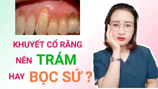 MÒN CỔ RĂNG NÊN TRÁM HAY BỌC SỨ? NGUYÊN NHÂN GÂY KHUYẾT CỔ RĂNG