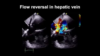 Echocardiography Essentials: Spotting tricuspid and pulmonary valve disease