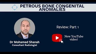 Investigation of Petrous Bone Congenital Anomalies By Mohammad Shannah