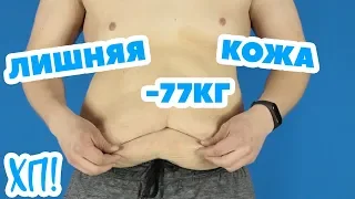 МОЯ КОЖА ПОСЛЕ ПОХУДЕНИЯ НА 77 КГ. 56 ЭПИЗОД.