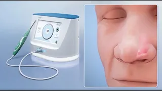 VivAer: A Non-Invasive Treatment for Nasal Obstruction