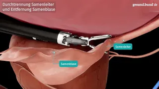 Was ist eine Roboter-assistierte Prostatektomie?