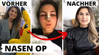 MEINE NASEN OP ➠ VORHER NACHHER BILDER, SCHMERZEN,KOSTEN, ABLAUF | TBATB