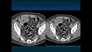 CT of the Small Bowel: Complications of Therapy and How They Mimic Pathology - Part 1