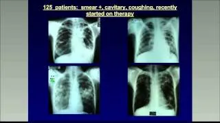 Basics of transmission control in an era of MDR-TB treatment