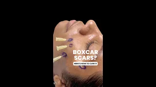The BEST Way to Get Rid of Boxcar Scars (Acne Scars)