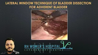 #80: Lateral Window Technique of Bladder Dissection for Adherent Bladder (Voiceover)