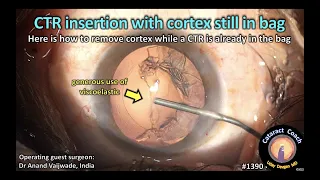 CataractCoach 1390: CTR  insertion with cortex still in bag