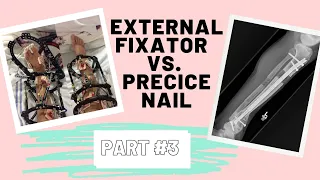 External Fixator vs. Precice Nail | Part #3