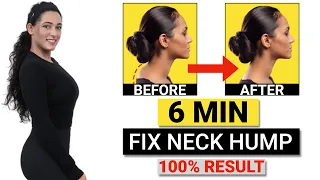 How to Fix a Neck Hump at Home (FAST)| Fix Neck Hump FAST With These Home Exercises! GymNought