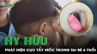 Bệnh Nhi 6 Tuổi Sốt Không Rõ Nguyên Nhân, Đi Khám Phát Hiện Cục Tẩy Mốc Nằm Trong Tai | SKĐS