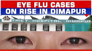 CONJUNCTIVITIS (EYE FLU) CASES ON RISE IN DIMAPUR