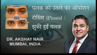 पलक को उठाने का ऑपरेशन (Ptosis) टोसिस / झुकी हुई पलक - Information Video - Dr. Akshay Nair, Mumbai