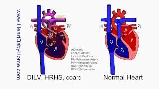 57 DILV, HRHS, coarc