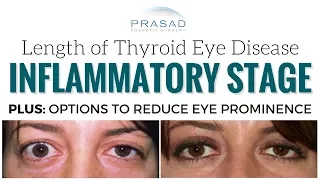 How Long Thyroid Eye Disease/Graves Disease Lasts, and Reducing Eye Prominence