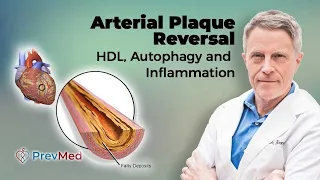 Arterial Plaque Reversal: HDL, Autophagy & Inflammation