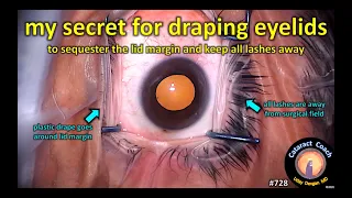 my secret for draping the eyelids in cataract surgery