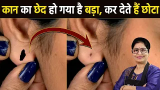 बिना ऑपरेशन, बिना टांके - सिर्फ 10 सेकंड में कान का बड़ा छेद करें छोटा | How To Reduce Ear Hole Size