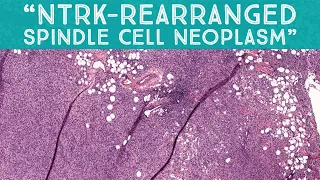 “NTRK-rearranged spindle cell neoplasm” (AIP France 2021 - Case 16) dermpath pathology dermatology