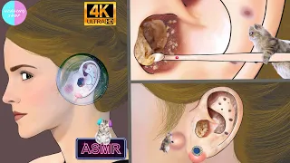 [ASMR] "I'll clear your clogged ears" blackhead, wax removal, ear cleaning animation asmr