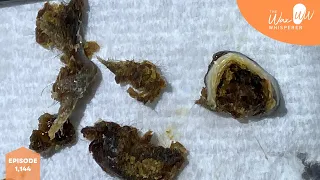 1,144 - Dead Skin Coated Ear Wax Plugs Removal