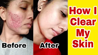 Remove Pimples, acne scars, Dark spot,Dermatologist Recommend Best Cream