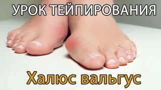 Тейпирование первого пальца на стопе при hallux-valgus